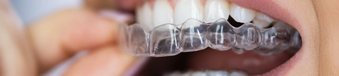 Paciente utilizando alinhadores Invisalign – tratamento ortodôntico estético com tecnologia avançada.